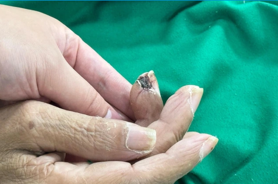 Không nên coi thường những vết thương nhỏ 